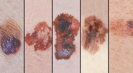 Melanoma bőrrák