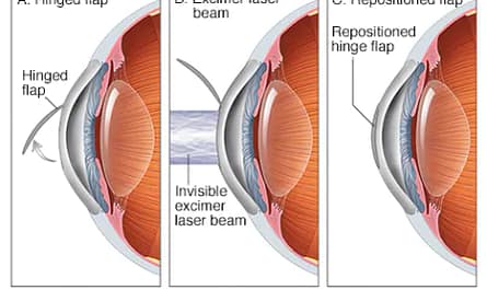 Lasik Lézeres szemműtét
