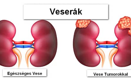Mi okozza a veserákot. Ki hajlamos a veserákra