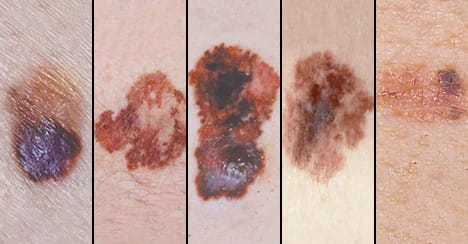 Bőrrák – Melanoma